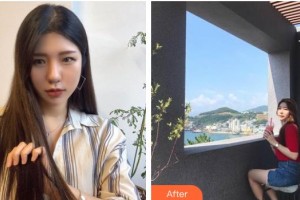 黑龍江省人民醫(yī)院整形美容中心劉俊整形價格表附切開雙眼皮案例展示