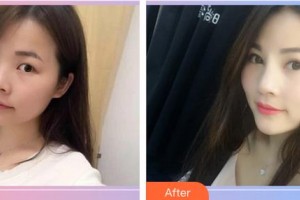 黑龍江中醫(yī)藥大學附屬第一醫(yī)院眼科王弘媛整形價格表附眼部修復案例展示