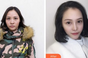 石家莊愛瑞爾醫(yī)療美容診所陳月整形價(jià)格表附眼部綜合案例展示