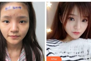 唐山美尚醫(yī)療美容診所余百林整形價格表附隆鼻案例展示