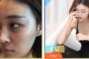 唐山金鳳凰美容整形醫(yī)院劉華濟(jì)整形價(jià)格表附自體脂肪隆胸案例展示