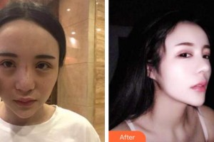 唐山煤醫(yī)整形美容醫(yī)院尹賢哲整形價(jià)格表附鼻部綜合案例展示