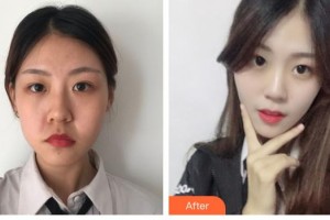 唐山煤醫(yī)整形美容醫(yī)院黃鎔碩整形價(jià)格表附埋線(xiàn)提升案例展示