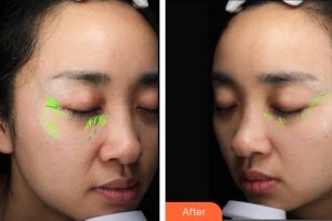 唐山星范醫(yī)療美容門診部劉俊偉整形價格表附埋線提升案例展示