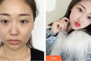 唐山灤縣人民醫(yī)院美容整形科齊向梅整形價(jià)格表附埋線(xiàn)提升案例展示