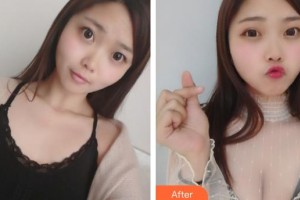 唐山灤縣人民醫(yī)院美容整形科吳永柏整形價格表附假體隆胸案例展示