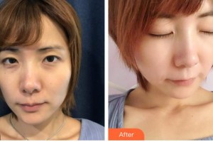 唐山市人民醫(yī)院燒傷整形科王永滿整形價(jià)格表附E光嫩膚案例展示