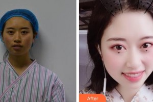 唐山星范醫(yī)療美容門診部劉勇整形價(jià)格表附埋線提升案例展示