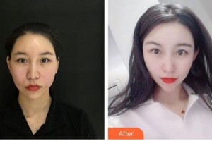 唐山祥云京城皮膚醫(yī)院趙鳳蘭整形價(jià)格表附埋線提升案例展示