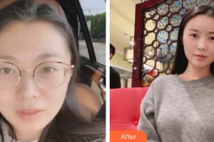 武漢仁愛時光醫(yī)院整形美容中心張紹斌整形價格表附自體脂肪填充案例展示