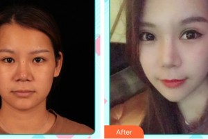唐山光明醫(yī)院李淑香整形價(jià)格表附切開雙眼皮案例展示
