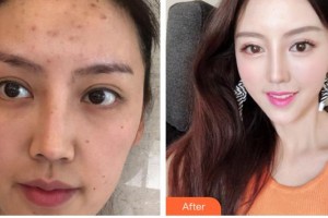 唐山惠美登醫(yī)療美容醫(yī)院瓦曼整形價(jià)格表附超聲提拉案例展示