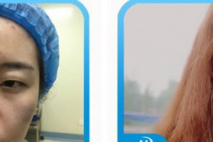 唐山光明醫(yī)院張瓏?yán)蝺r(jià)格表附埋線雙眼皮案例展示