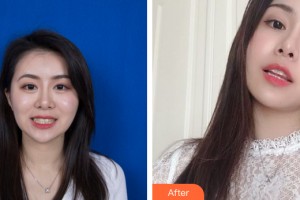 武漢美齊口腔門診部張文整形價(jià)格表附牙齒矯正案例展示