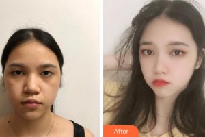 秦皇島紀(jì)輝整形美容醫(yī)院王雯整形價(jià)格表附去痘印痘坑案例展示