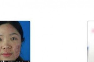 秦皇島紀(jì)輝整形美容醫(yī)院金翰相整形價(jià)格表附清潔祛痘案例展示