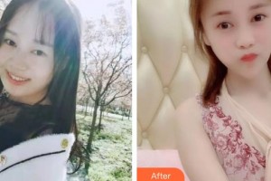 秦皇島巧致美容醫(yī)院任加偉整形價(jià)格表附埋線提升案例展示