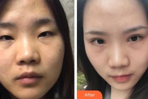 秦皇島巧致美容醫(yī)院于民整形價(jià)格表附切開雙眼皮案例展示