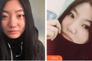 秦皇島紀(jì)輝整形美容醫(yī)院崔炳龍教授整形價(jià)格表附埋線雙眼皮案例展示