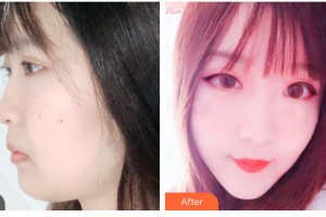 秦皇島友誼醫(yī)院整形美容外科王國光整形價(jià)格表附埋線提升案例展示