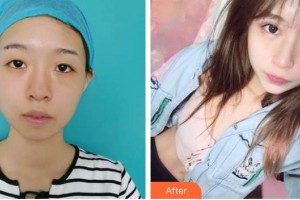 秦皇島紀(jì)輝整形美容醫(yī)院廉樂天整形價(jià)格表附眼部綜合案例展示