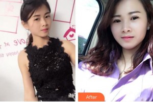 秦皇島巧致美容醫(yī)院高華整形價(jià)格表附切開雙眼皮案例展示