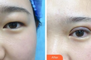 秦皇島念奴嬌醫(yī)療美容門診部王權(quán)整形價(jià)格表附眼部綜合案例展示