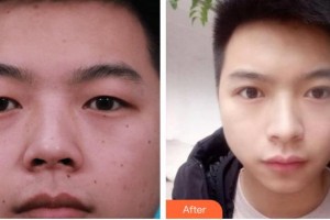 秦皇島念奴嬌醫(yī)療美容門診部馬艷艷整形價(jià)格表附切開雙眼皮案例展示