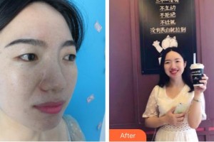 秦皇島釹娃（原女娃）醫(yī)療美容診所張曉陽整形價(jià)格表附光子嫩膚案例展示