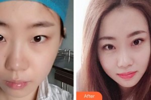 秦皇島匠心醫(yī)美醫(yī)療美容診所謝冰整形價(jià)格表附眼部綜合案例展示