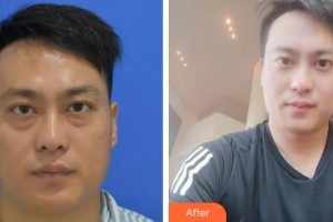 秦皇島愛爾眼科醫(yī)院張海東整形價(jià)格表附激光去眼袋案例展示