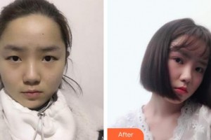 秦皇島和生醫(yī)療美容門診部劉雷整形價(jià)格表附眼部綜合案例展示