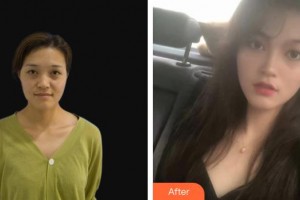 秦皇島愛爾眼科醫(yī)院張巖整形價(jià)格表附眼部綜合案例展示