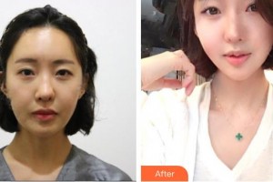 唐山光明醫(yī)院尹亞玲整形價(jià)格表附微針美膚案例展示