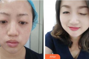 唐山光明醫(yī)院馬允錦整形價(jià)格表附祛斑祛痣案例展示