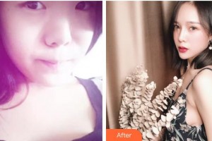 唐山光明醫(yī)院樊鄭軍整形價(jià)格表附眼部綜合案例展示