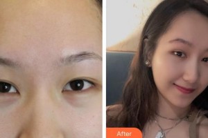 唐山冀東眼科醫(yī)院于秋菊整形價(jià)格表附切眉術(shù)案例展示