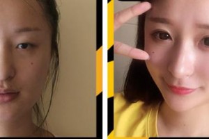 唐山冀東眼科醫(yī)院李玉濤整形價(jià)格表附埋線雙眼皮案例展示