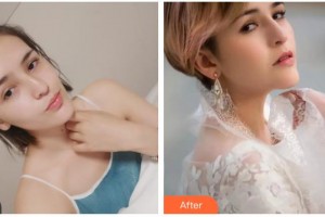 唐山冀東眼科醫(yī)院張成整形價(jià)格表附切開雙眼皮案例展示