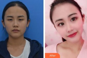 唐山光明醫(yī)院高斌儒整形價(jià)格表附定點(diǎn)雙眼皮案例展示