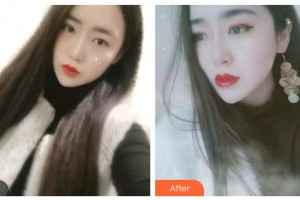 唐山牙博士口腔醫(yī)院張靜整形價(jià)格表附金屬托槽矯正案例展示