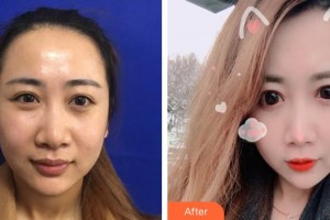 邯鄲曲勝星范醫(yī)療美容門診部史振醫(yī)師整形價(jià)格表附埋線提升案例展示