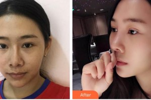 邯鄲韓雅醫(yī)療美容診所楊利民整形價格表附鼻部綜合案例展示