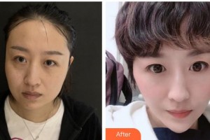 邯鄲都市整形美容醫(yī)院李秀蘭整形價格表附埋線提升案例展示