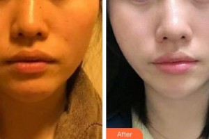 邢臺人民醫(yī)院醫(yī)學(xué)美容科李麗莎住院醫(yī)師整形價格表附埋線提升案例展示