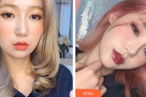 邢臺人民醫(yī)院醫(yī)學(xué)美容科張玉整形價格表附埋線提升案例展示