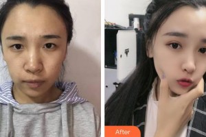 邢臺尚美醫(yī)療美容醫(yī)院劉輝整形價格表附埋線提升案例展示