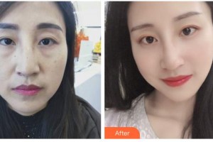 邢臺美加美醫(yī)療美容診所韓美整形價格表附定點雙眼皮案例展示