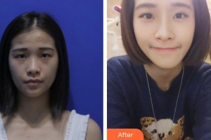 邢臺伊美醫(yī)療美容診所李學(xué)英整形價格表附眼部綜合案例展示