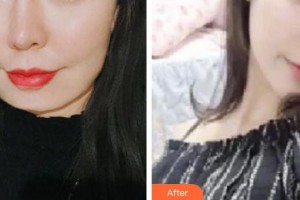 邢臺美加美醫(yī)療美容診所陳譽華整形價格表附切開雙眼皮案例展示